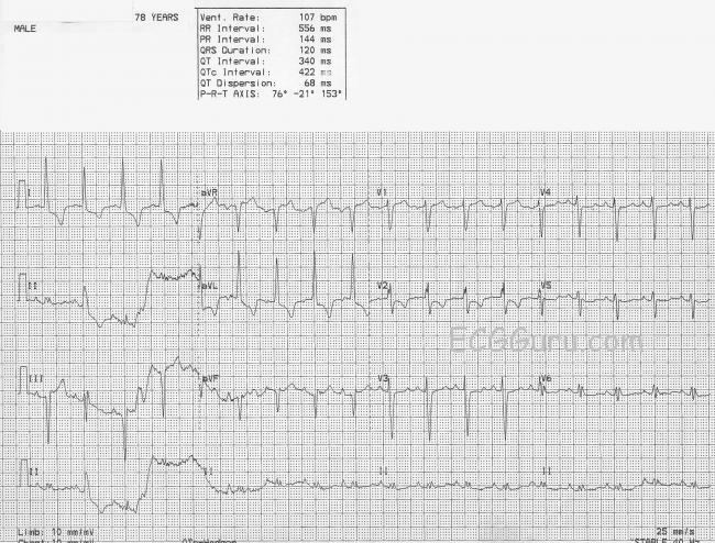 loose-electrode-artifact-ecg-guru-instructor-resources